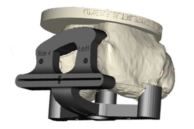 <p>360 Knee Systems specialize in delivering innovative technological solutions for total knee replacement surgery. They work with orthopedic surgeons to provide dynamic, functional, and patient-specific planning and simulation solutions.</p>
<p>With Simpleware software, 360 Knee Systems have developed patient-specific preoperative plans that rely on creating accurate representations of patient bone geometry to solve challenges inherent to total knee replacements.</p>
