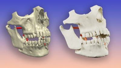 3D Printed Jaw Scan | 
