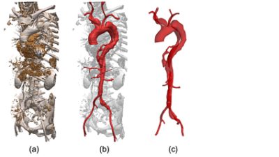 Segmentation of aortic dissection in Simpleware ScanIP