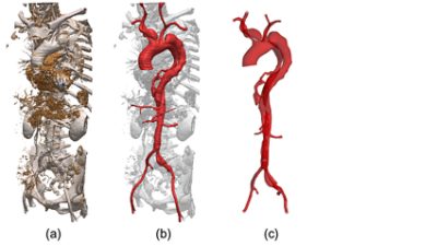 Segmentation of aortic dissection | ϲֱ