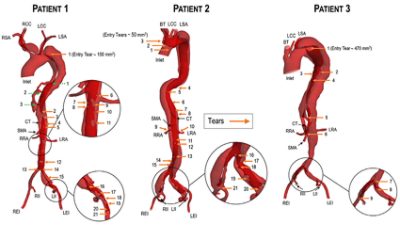 Aortic dissections of 3 different patentients in Simpleware ScanIP