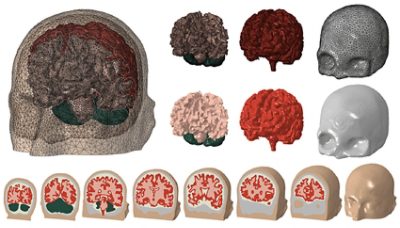 Segmentation of the skull and brain in Simpleware software | 