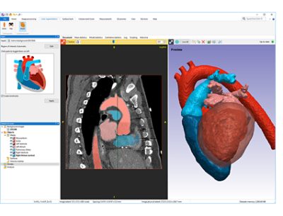 <p>Simpleware? software accelerates medical device production and R&amp;D workflows by allowing users to leverage machine learning-based AI to automate the segmentation of anatomical structures from 3D image data such as MRI and CT.</p>