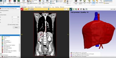 What is Medical 3D Printing?