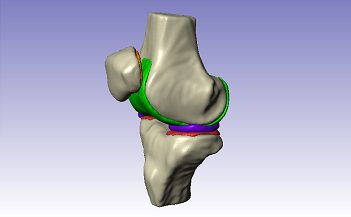 <p>Use Simpleware software for medical image segmentation, medical image processing and model generation for orthopedic applications. Gain insights into patient-specific implant designs and save time with 3D medical imaging software workflows for exploring designs and simulating real-world scenarios.</p>
<p>Simpleware software has received CE and FDA 510(k) market clearance for the following <a href="/content/synopsys/en-us/simpleware/resources/regulatory.html">Indications for Use</a>.</p>
