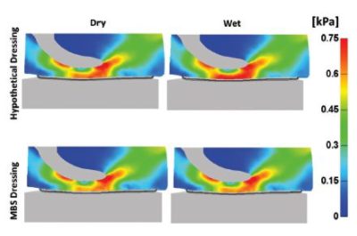 MRI slices and Simpleware ScanIP model showing heart-shaped multilayer prophylactic dressing.