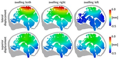 Computational simulation of decompressive craniectomy