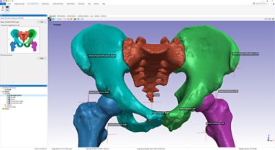  Simpleware AS Ortho hip segmentation tool and output 