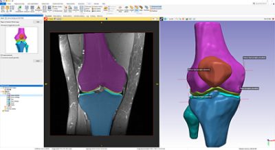 S impleware AS Ortho knee segmentation tool and output 