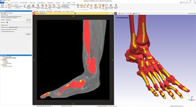  Use the Fill Gaps tool in Simpleware ScanIP to close up cavities inside objects 