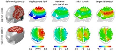 Midline shift for three different scenarios of brain swelling