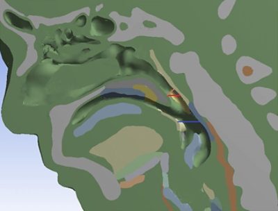 Analysis of the role of passive mechanical deformation in the human pharynx to upper airway collapse is fundamental to understanding how airway patency is maintained. Finite Element Analysis (FEA) was used in this study to examine deformation using a detailed 3D anatomical model that was created in Simpleware software from CT scans. Results showed good agreement with in vivo testing and the literature, providing a starting point for more comprehensive simulations of human upper airway collapse and obstructive sleep apnea therapy.