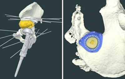 <p>3D LifePrints use Synopsys Simpleware software to go from patient-specific images to 3D printed anatomical models used for 3D virtual simulation and physical (medical device) surgical guides. Simpleware software’s clearances for diagnostic 3D printing is helping 3D LifePrints implement their reach in Point of Care (POC) 3D printing, including via embedded clinical hubs.</p>
<p>One of the key specialties for 3D LifePrints is in oncology surgery through their work at several specialist hospitals in the UK, where their engineers help surgical teams on difficult and complex cases involving design &amp; manufacture of cutting guides to aid the surgery. We have highlighted two recent success stories, covering a hemipelvectomy and a targeted resection of the ilium.</p>
