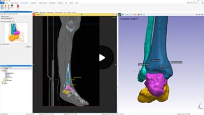 Ankle Segmentation | Synopsys Simpleware