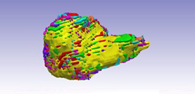 Segmentation of brain tumor growth in 17Թ Simpleware software