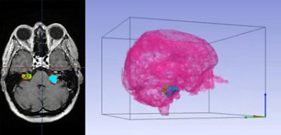 2D cross-section and 3D reconstruction of brain and tumor in 17Թ Simpleware software