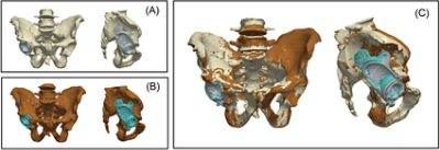 Pelvis and cup registration in Simpleware software (CC BY 4.0)