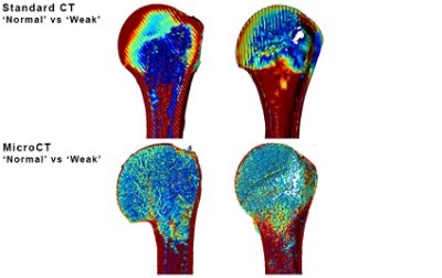 'Normal' vs. 'weak' areas of bone density in a standard clinical CT and microCT