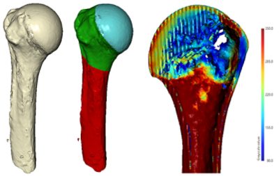 Reconstruction of clinical CT scans and bone density measurements in Simpleware software