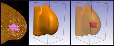 Segmentation of breast tumor | 