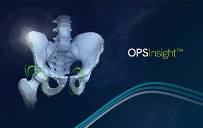 <p>Corin uses Simpleware software as part of its Optimized Positioning System (OPS) workflow for planning patient-specific total hip arthroplasties (THAs). ϲֱ and Corin have been working together to streamline the OPS workflow and eliminate segmentation and landmarking bottlenecks. Automation of these steps using Simpleware AI technology has particularly helped to free up resources and reduce image processing time by 94% per case.</p>
<p>By utilizing this technology, Corin OPS provides a fast, scalable, and clinically accurate pre-operative planning platform that has already been used in over 20,000 total hip procedures worldwide.</p>
