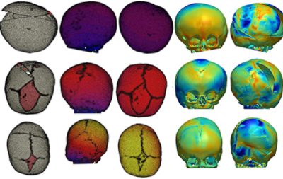 <p>Lambdoid craniosynostosis (LC) is a rare non-syndromic craniosynostosis characterized by fusion at birth of the lambdoid sutures at the back of the head. While surgical options such as spring-assisted cranioplasty are available, the aesthetic results are often suboptimal. To tackle this problem, a parametric Finite Element (FE) model of the LC skulls was developed to optimize future spring surgeries.&nbsp;</p>
<p>Skull geometries from three different LC patients who had undergone spring correction were reconstructed from pre-operative CT data in Simpleware software. Simulation was carried out to compare the skull growth between the pre-operative CT imaging and the surgery. By reproducing this procedure in a virtual setting, this approach may help to improve LC surgeries in future.</p>
