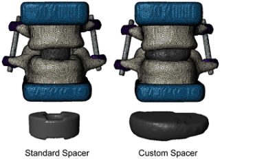 Lumbar interbody fusion project from the CU Denver SMAB Lab