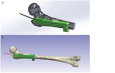 Virtual modeling of surgical guide and femur using Simpleware (CC BY 4.0)
