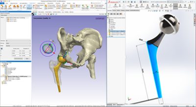 Push or pull changes between SOLIDWORKS? and Simpleware ScanIP for designing a patient-specific hip implant