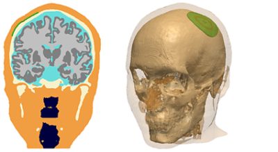 Human head model in Simpleware ScanIP after electrode implantation