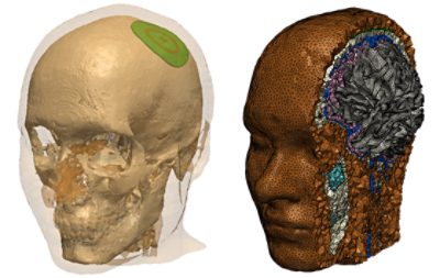 Epicranial cortical stimulation (ECS) is a novel neuromodulation technique that has the advantage of delivering strong electric field to the brain in a minimally invasive manner. To show the potential, computational modeling becomes necessary in order to evaluate electric fields within soft tissue. For this purpose, researchers at KU Leuven used Simpleware software to create a model of a real human head implanted with ECS electrodes and to generate tetrahedral meshes, which were exported to an external simulation software (COMSOL Multiphysics?). An important feature in Simpleware software is the ability to generate high-quality meshes with high density at the region of interest (ROI) which could produce accurate results in a cost-effective way. The results from this work were published in Frontiers in Neuroscience.