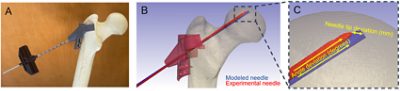 3D printed drill guide: comparing needle placement position (CC BY 4.0)