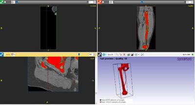 Automatic segmentation of the femur and pelvis in Simpleware software (CC BY 4.0)