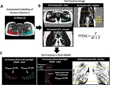 Intramuscular fat in gluteus maximus (CC BY 4.0)