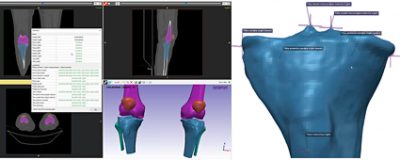 Automated tibia segmentation using Simpleware AS Ortho/CMF.