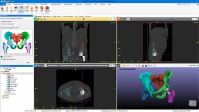 The Simpleware Hip Revision CT tool