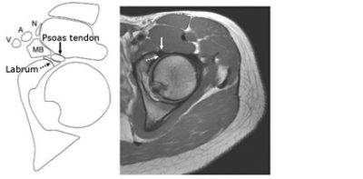 Hip CT scan showing the location of the iliopsoas tendon