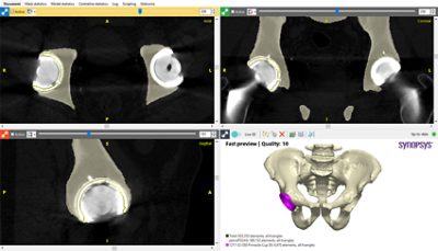 Segmented postoperative hip CT scan with a registered hip resurfacing implant in Synopsys Simpleware