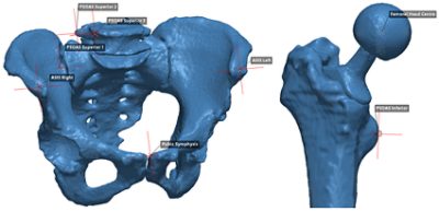 Landmarks placed on a segmented hip CT scan in Synopsys Simpleware