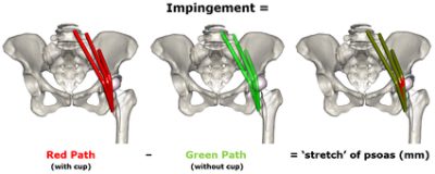 Schematic of iliopsoas impingement simulation