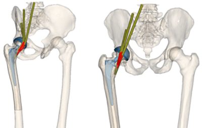 Simulation of iliopsoas tendonitis after different hip surgeries