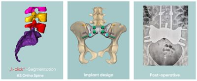 Simpleware Spine CT tool perfectly segments the small intervertebral joints