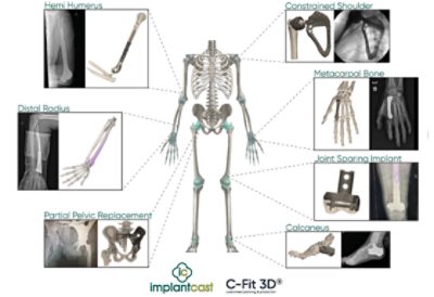 Overview of the implantcast C-Fit 3D system