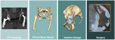 implantcast custom implant workflow for partial pelvic replacement