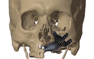 <p>Jajal Medical Services use °ϲʿ Simpleware software to help convert patient scan data (such as from CT and MRI) into 3D STL and Finite Element (FE) models suitable for visualizing and planning complex surgeries. Digital surgical planning workflows are becoming increasingly valuable for reducing the risk of unexpected complications during surgery, thus&nbsp;reducing operating room (OR) time and saving money, and for improving clinical outcomes and patient satisfaction.</p>
<p>For this case, Jajal Medical needed to optimize a custom maxillary implant design for a patient suffering from the pathological condition mucormycosis, which results in considerable loss of the left maxilla bone. Simpleware software and Ansys software were used to complete this process.</p>
