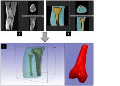 Segmented knee from MRI using Simpleware software (CC BY 4.0)