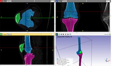 Knee Replacement