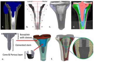 Patient-specific knee replacement model with DXA image and CAD data (CC BY 4.0)