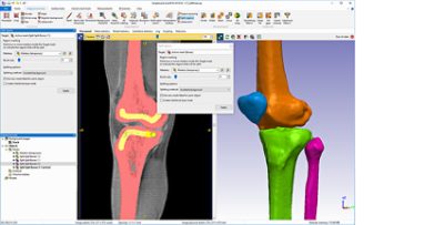 Knee segmentation with split regions tool in Simpleware software