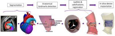 Patient-specific TAVI simulation workflow using Simpleware software